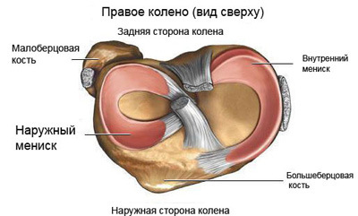 повреждение мениска колена
