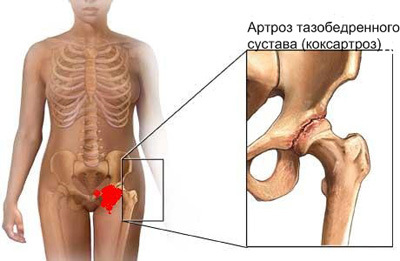 остеоартроз тазобедренного сустава