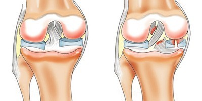 povrezhdenie-meniska-kolennogo-sustava