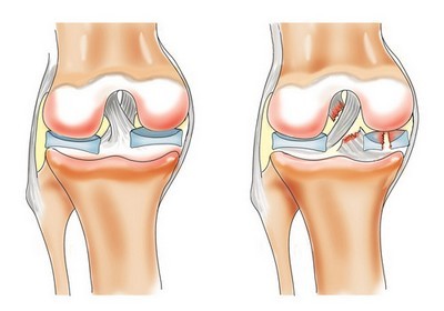 изображение коленной связки здоровой и порванной