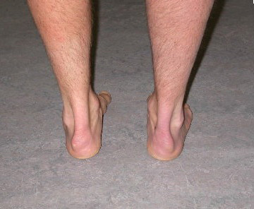 фото больных ног