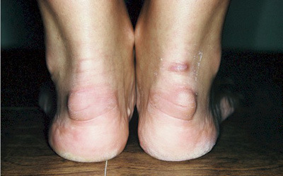 ноги больные ахиллобурситом