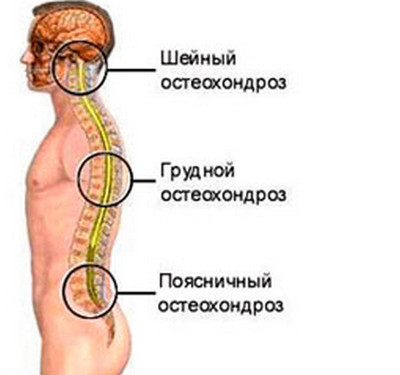 плакат с расположением остеохондроза