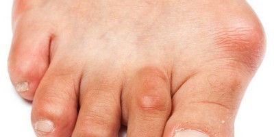 лечение бурсита большого пальца стопы