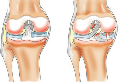 киста коленного сустава симптомы киста коленного сустава лечение народными средствами