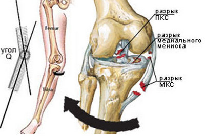 повреждение связок коленного сустава лечение