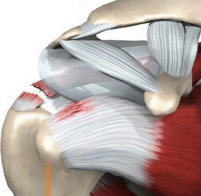 лечение разрыва связок плечевого сустава разрыв ключичных связок плечевого сустава