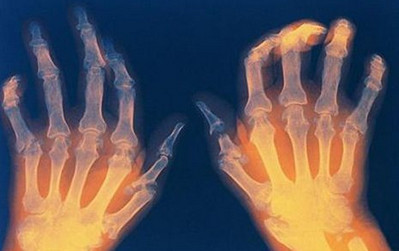 снимок с рентгеном ревматоидного полиартрита