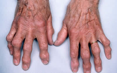суставы пальцев с деформирующим артрозом