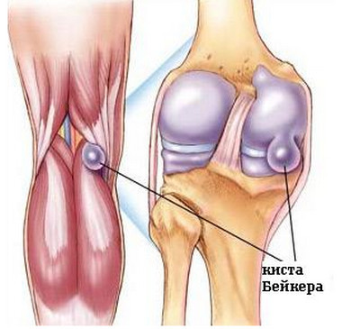 лечение кисты коленного сустава