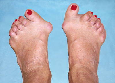 Фото ноги с ревматоидным артритом
