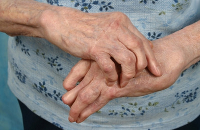 фото руки больной полиартритом