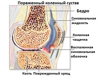 воспаленный коленный сустав