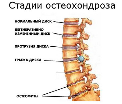 плакат стадий развития остеохондроза