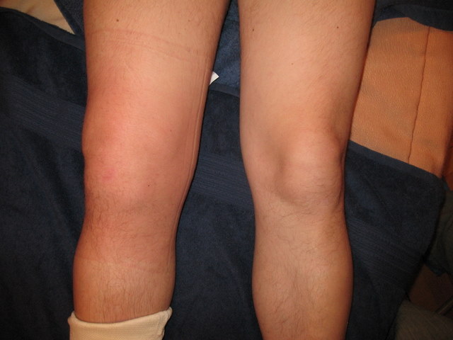 гигрома коленного сустава лечение народными средствами