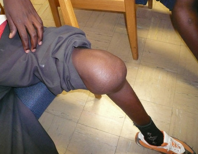 синовит коленного сустава лечение народными средствами 