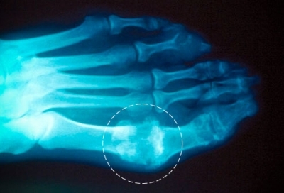 снимок с рентгеном подагры
