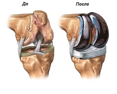 наглядное изображение протеза сустава