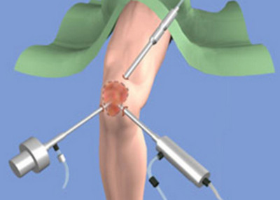операция на мениске коленного сустава 