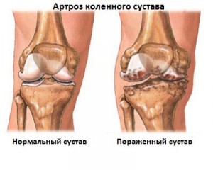 повреждение колена артрозом