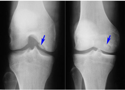 коленные суставы при рентгене