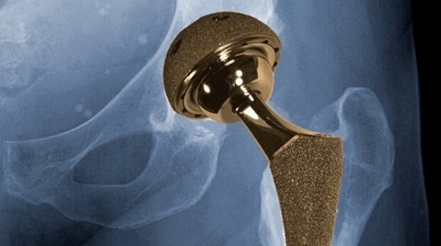 артрит и протезирование