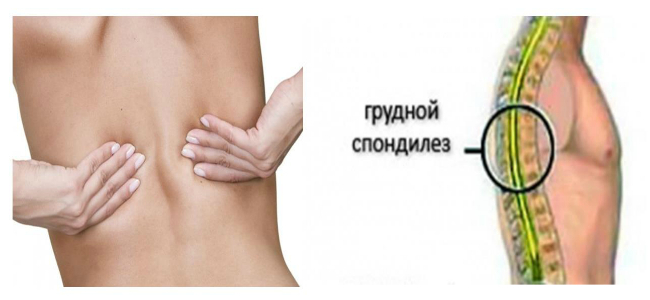 Спондилез грудного отдела позвоночника