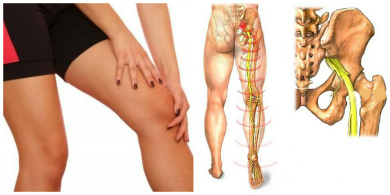 Симптомы защемления нерва в ноге