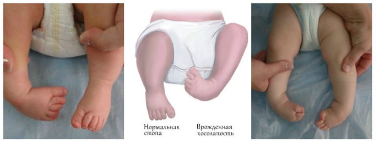 Массаж при косолапости все о нем Массаж при косолапости все о нем