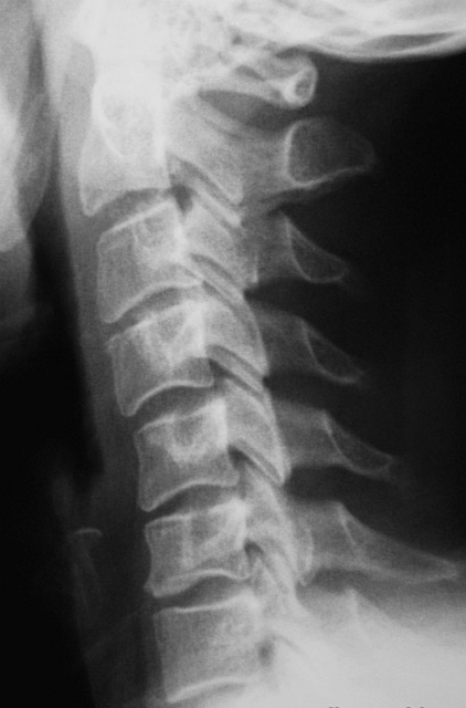 Рентгенограмма шейного отдела позвоночника.