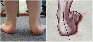 Причины вальгусной деформации стопы у детей
