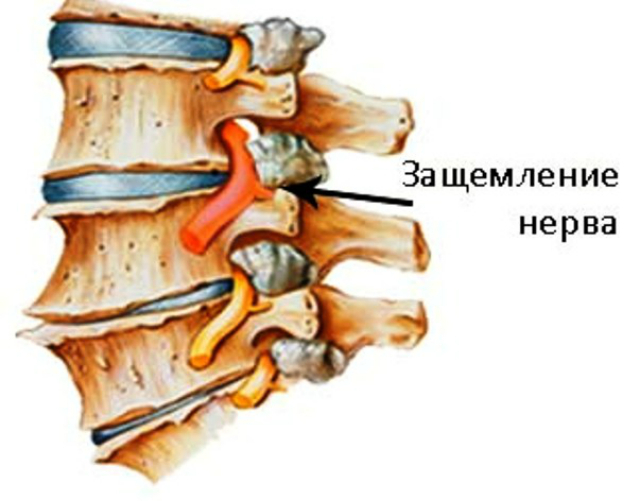 Что делать если позвоночник защемил нерв Что делать если позвоночник защемил нерв