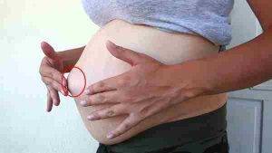 Грыжа белой линии живота при беременности