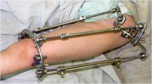 Аппарат Илизарова при лечении ложного сустава