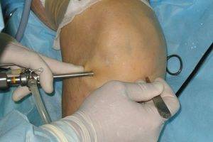 эндоскопическая артроскопия коленного сустава
