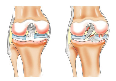 povrezhdenie-meniska-kolennogo-sustava