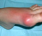 воспаление сустава большого пальца ноги