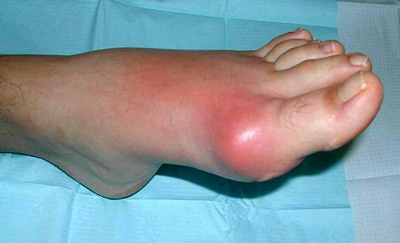 воспаление сустава большого пальца ноги