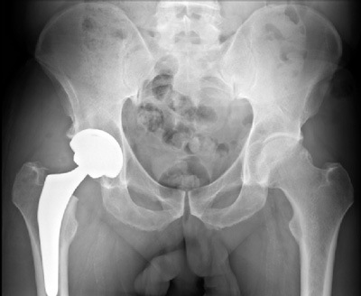 фото с рентгеном импланта в тазобедренном суставе