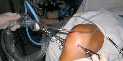 Реабилитация после артроскопии коленного сустава: отзывы