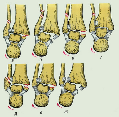 семь видов повреждения голеностопного сустав