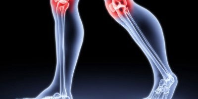 как лечить артрит коленного сустава