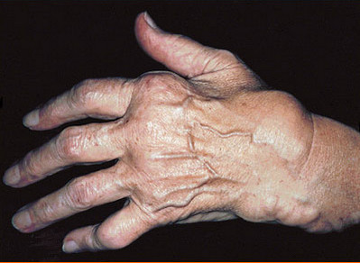 артрит суставов пальцев рук