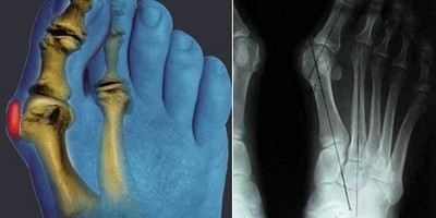 Деформирующий остеоартроз стопы – как и чем лечить?