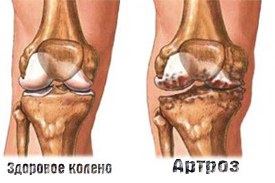 разница между здоровым и больным коленом