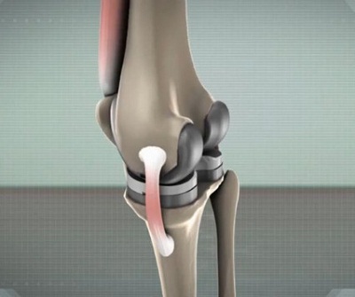 протезируем коленный сустав