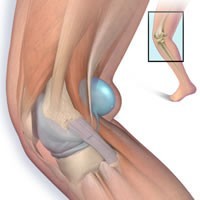 Что произойдет с подколенной кистой Беккера после эндопротезирования коленного сустава?