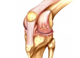 Можно ли вылечить коленный сустав без операции?