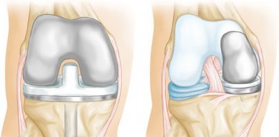 Протезирование коленного сустава при болезни Паркинсона