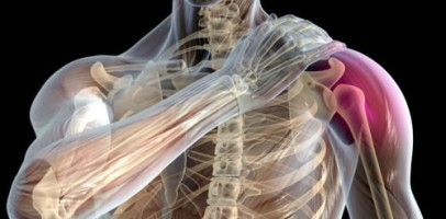 Лечение плексита плечевого сплетения